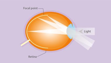 Gestão da miopia versus correção da miopia Gestão da miopia versus correção da miopia